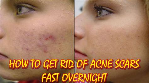 boni scars|14 Ways to Get Rid of Acne Scars